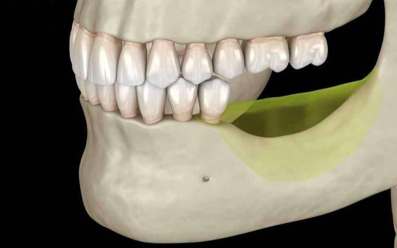 Tiêu xương hàm rất khó để thực hiện trồng răng
