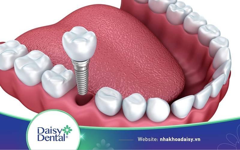 Quy trình trồng răng Implant