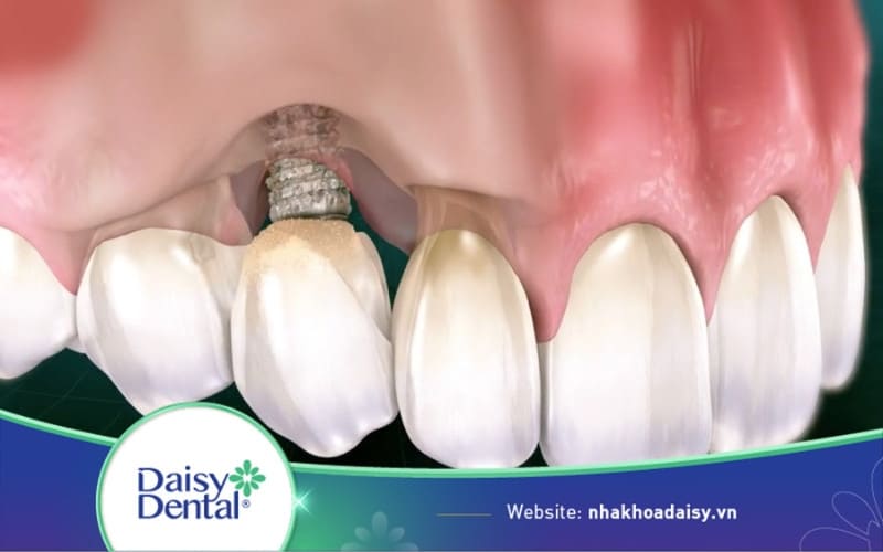 răng implant bị đào thải