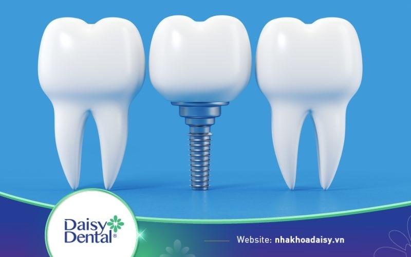 Trồng răng Implant trả góp
