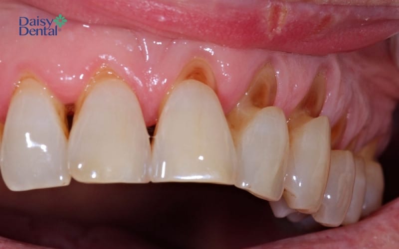 Tình trạng cổ chân răng bị mài mòn do tụt lợi lâu ngày