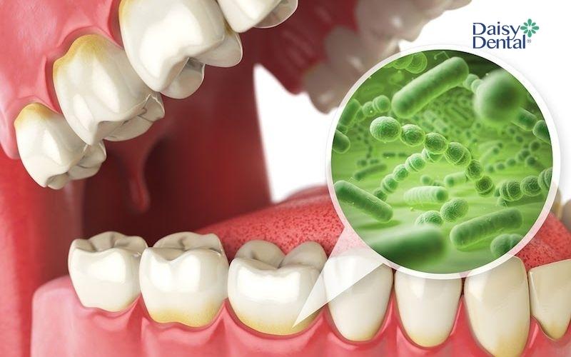 Trên bề mặt cao răng có rất nhiều vi khuẩn tích tụ gây sâu răng