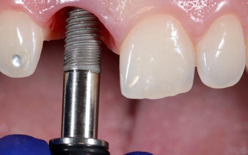Trồng răng Implant sớm ngăn ngừa được tình trạng tiêu xương hàm
