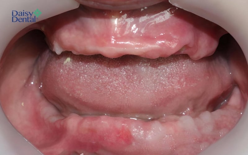 Trụ Implant Kontact không thể dùng trong trường hợp mất răng toàn hàm