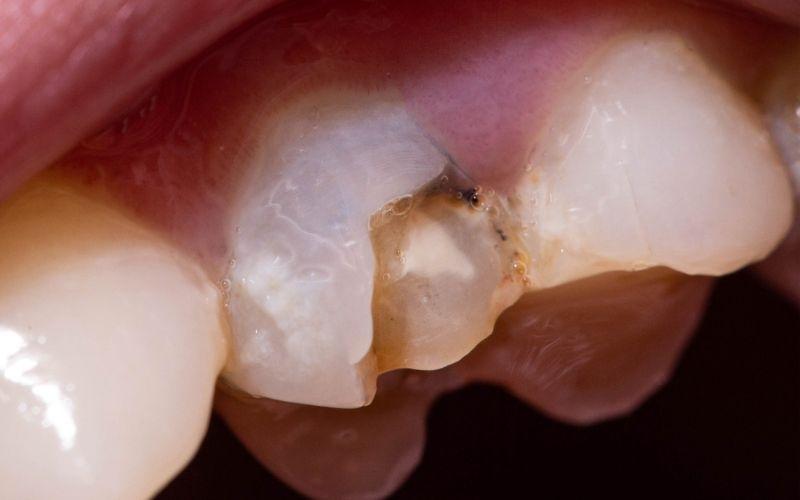 Tủy răng số 7 bị viêm gây nhiều biến chứng nguy hiểm