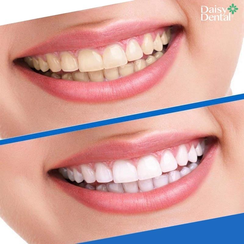 3D White Teeth Whitening Strip chỉ dùng cho răng ố vàng nhẹ