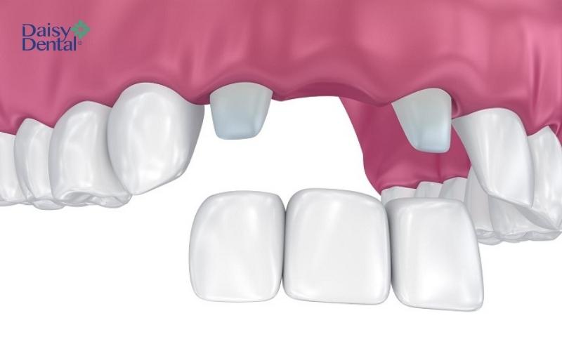 Bắc cầu răng sứ chỉ được thực hiện khi hai chiếc răng hai bên răng bị mất khỏe mạnh, chắc chắn