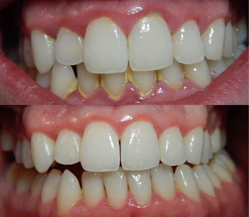 Các cách làm rụng cao răng tại nhà chỉ có thể áp dụng khi lớp mảng bám mới vừa hình thành