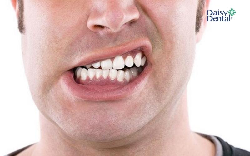 Hạn chế nghiến răng để tránh làm lợi bị co rút