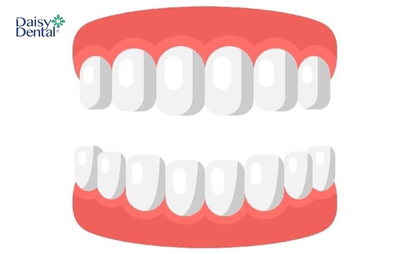 Khả năng ăn nhai, tính thẩm mỹ của người bị thiếu răng sẽ bị suy giảm