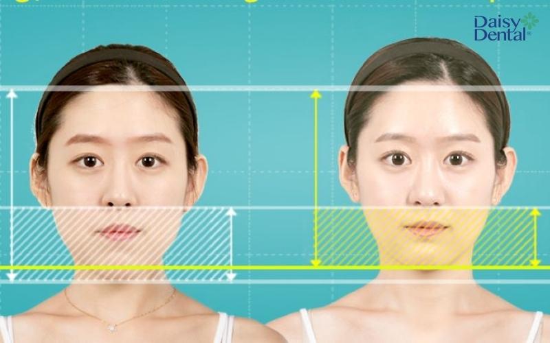 Khuôn mặt dài có tỷ lệ kém cân đối so với bình thường