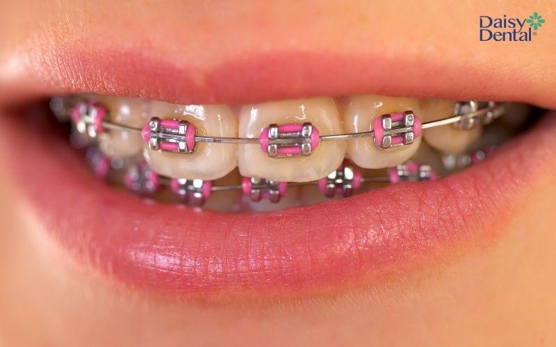 Miếng dán trắng răng Oral 3D White chống chỉ định với người đang niềng răng