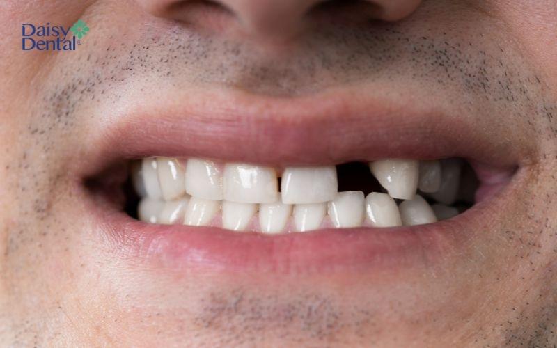 Người bị mất răng nhưng không đi trồng lại dẫn đến thiếu hụt răng