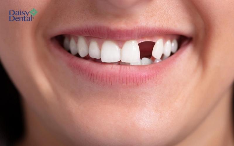 Răng ở vị trí răng nanh bị thiếu làm ảnh hưởng đến tính thẩm mỹ của gương mặt