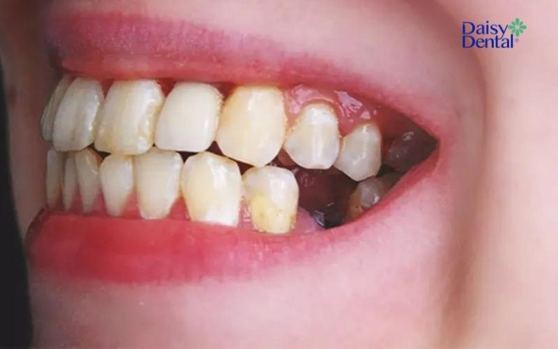 Rụng răng hàm dưới không chảy máu mang ý nghĩa khác nhau theo văn hóa từng khu vực