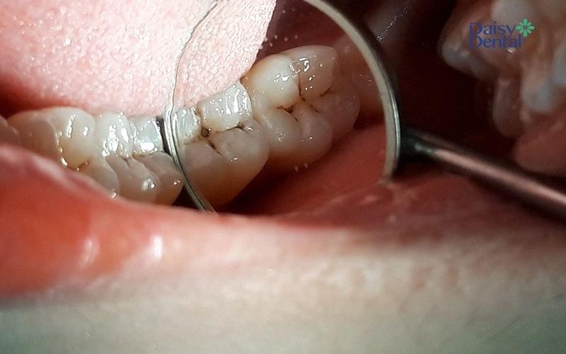 Sâu răng nhẹ là hiện tượng bề mặt răng xuất hiện đốm nhỏ màu trắng đục hoặc nâu đen