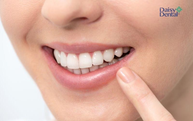 Tẩy trắng răng là phương pháp an toàn cho sức khỏe và không gây hại đến men răng