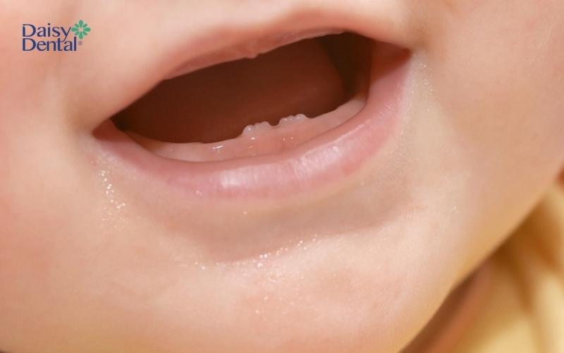 Thiếu răng có thể là do di truyền