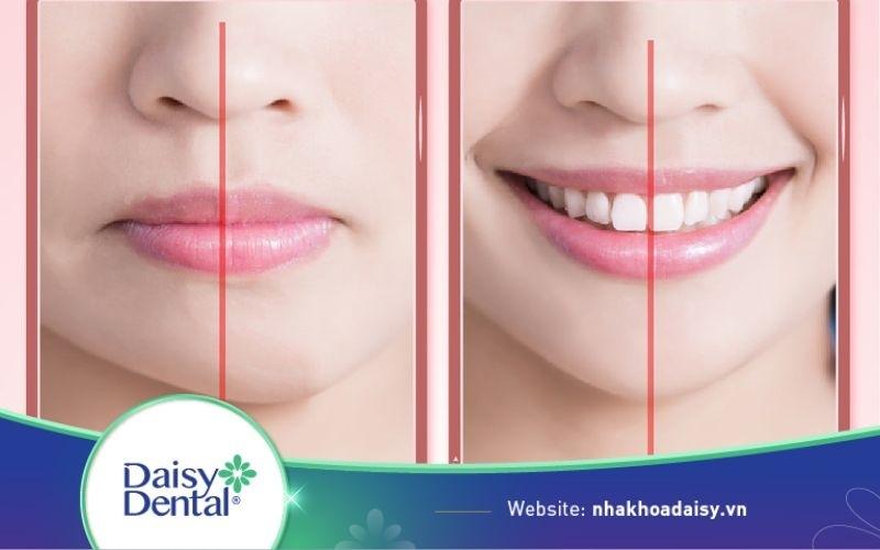 Mặt lệch bên phải thì nhai bên nào