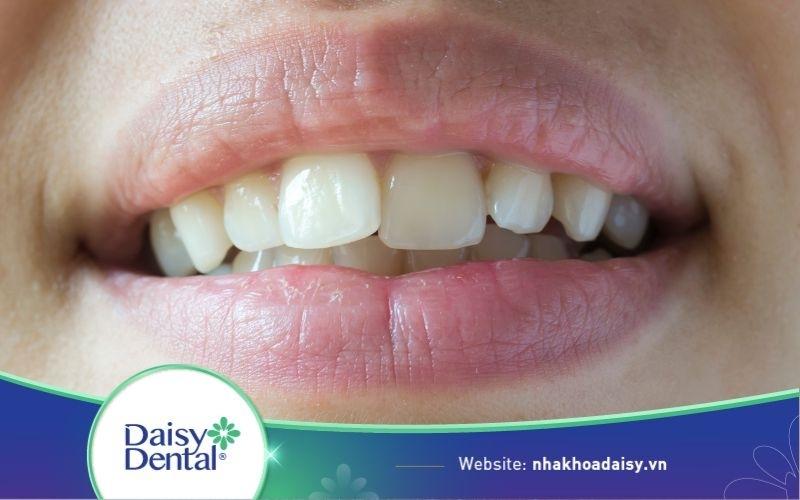 Người có 36 cái răng có sao không? Vận mệnh thế nào?