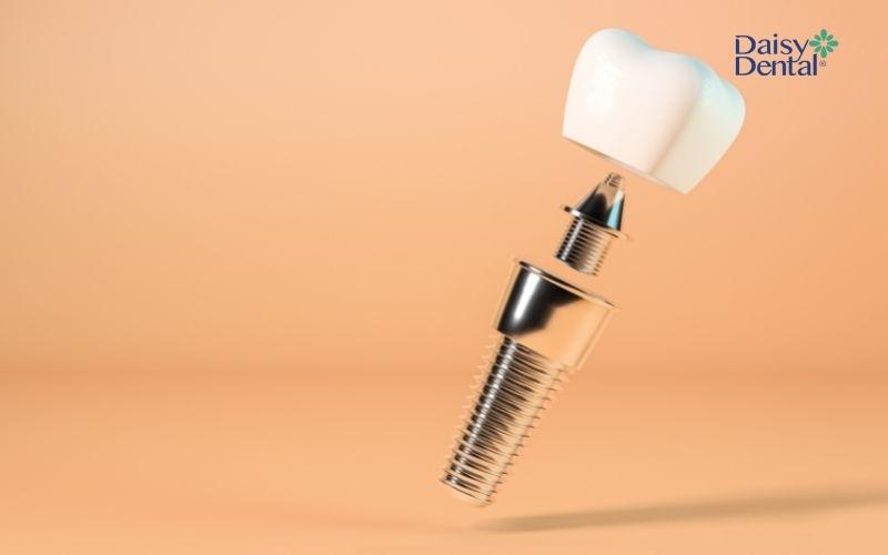 Trồng răng Implant khi mất răng nanh