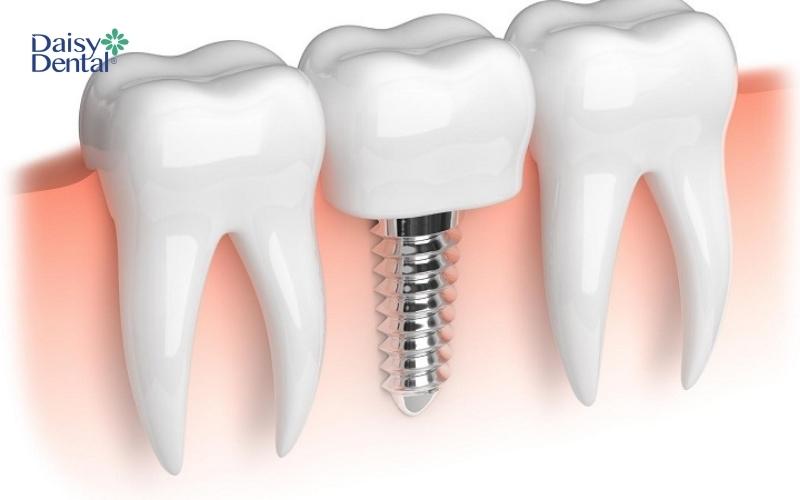 Trồng răng Implant là phương pháp khôi phục răng bị mất tối ưu nhất