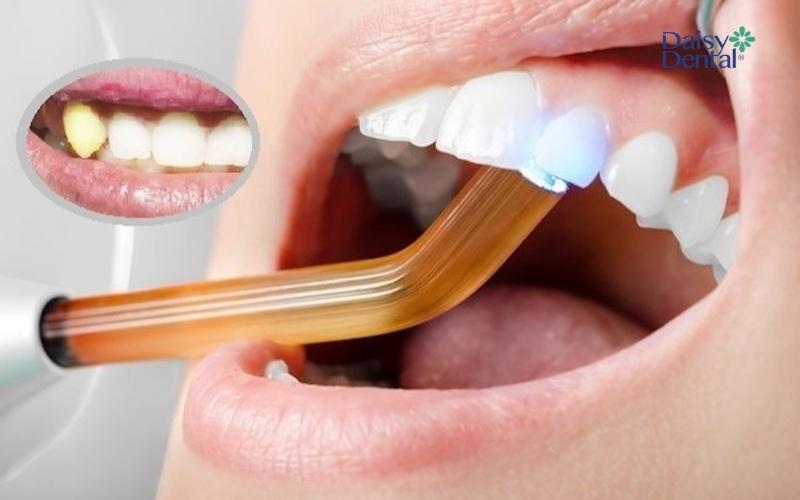 Trồng răng nanh bằng cách đắp Composite được nhiều người lựa chọn