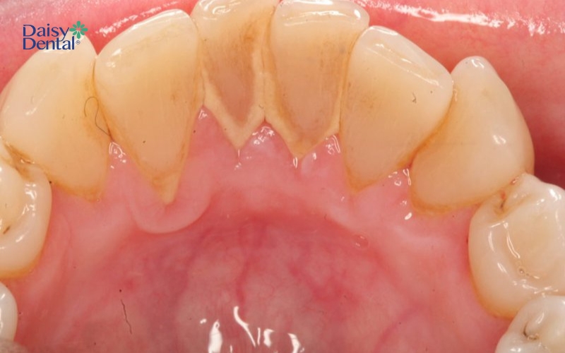 Các cách lấy cao răng bằng muối chỉ hiệu quả đối với trường hợp cao răng mới hình thành