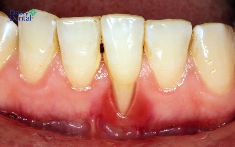 Cao răng bị đen có thể dẫn đến tiêu xương hàm, gây mất răng