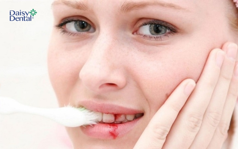 Cao răng bị đen do hấp thụ sắc tố từ máu