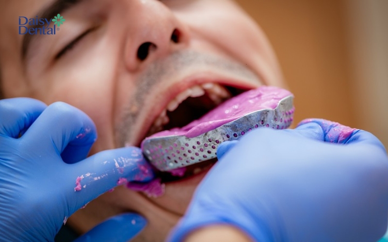 Lấy dấu răng là bước không thể thiếu trước khi thực hiện các kỹ thuật nha khoa thẩm mỹ