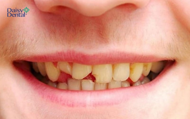 Mơ thấy nhiều răng bị mẻ báo hiệu xui xẻo sắp đến với bạn