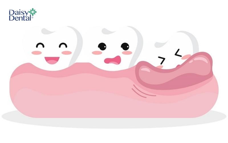 Người có 29 cái răng là vì xuất hiện chiếc răng khôn đầu tiên