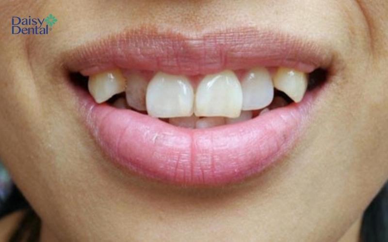 Nha sĩ không khuyến khích nhổ răng nanh nếu răng không bị tổn thương quá nghiêm trọng