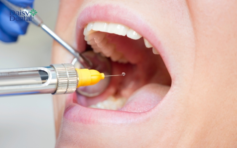 Nha sĩ tiến hành gây tê trước khi thực hiện nhổ răng