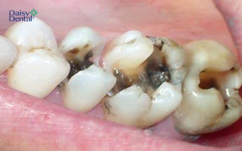 Răng hàm bị sâu không được điều trị có thể dẫn đến hoại tử chân răng, gây mất răng