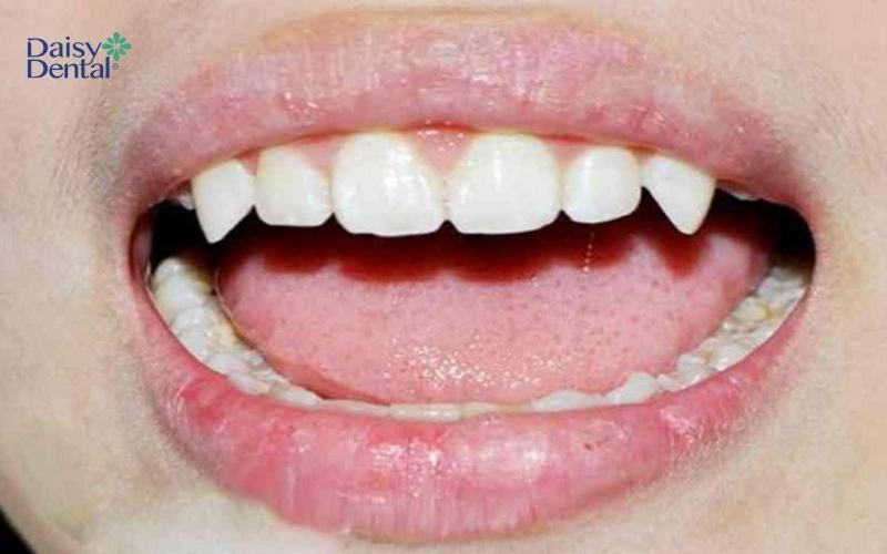 Răng ở vị trí thứ 3 sắc nhọn sẽ được gọi là răng nanh nhọn