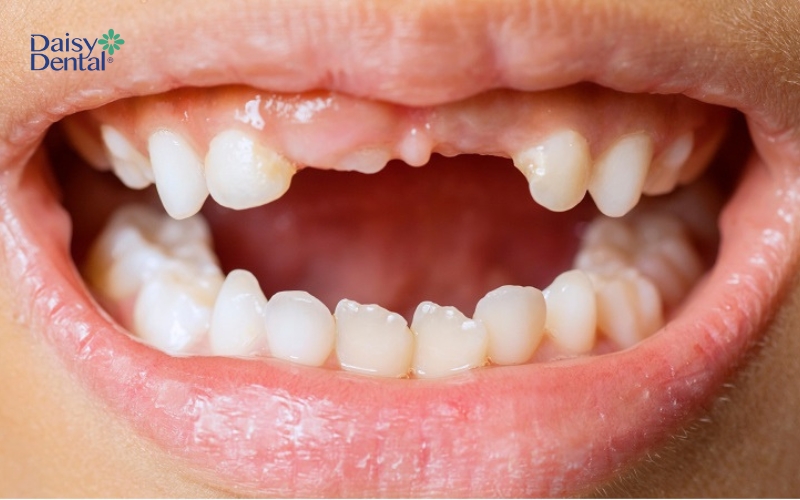 Răng vĩnh viễn lâu xuất hiện có thể là do răng mọc ngầm