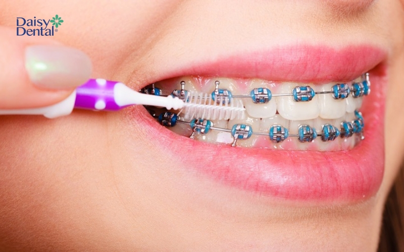 Sử dụng bàn chải kẽ để loại bỏ mảng bám trên răng
