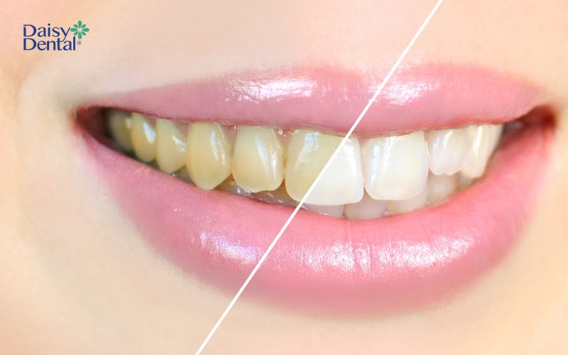 Philips Zoom duy trì hiệu quả làm trắng răng dài lâu