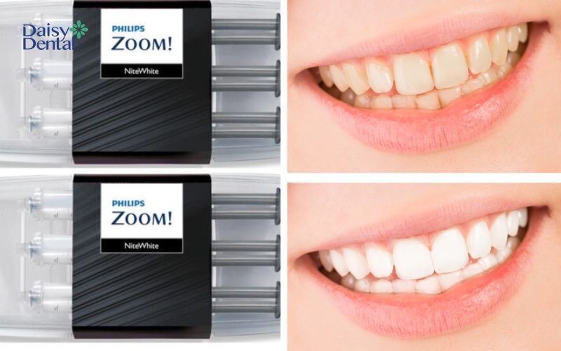 Thuốc tẩy trắng Philips Zoom NiteWhite có công dụng làm trắng răng vượt trội