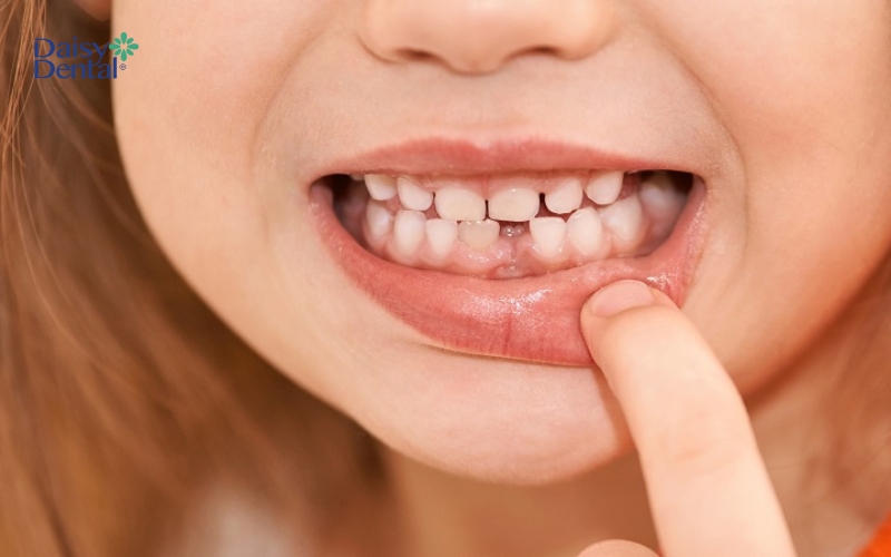 Trẻ em tổng cộng có 20 cái răng sữa