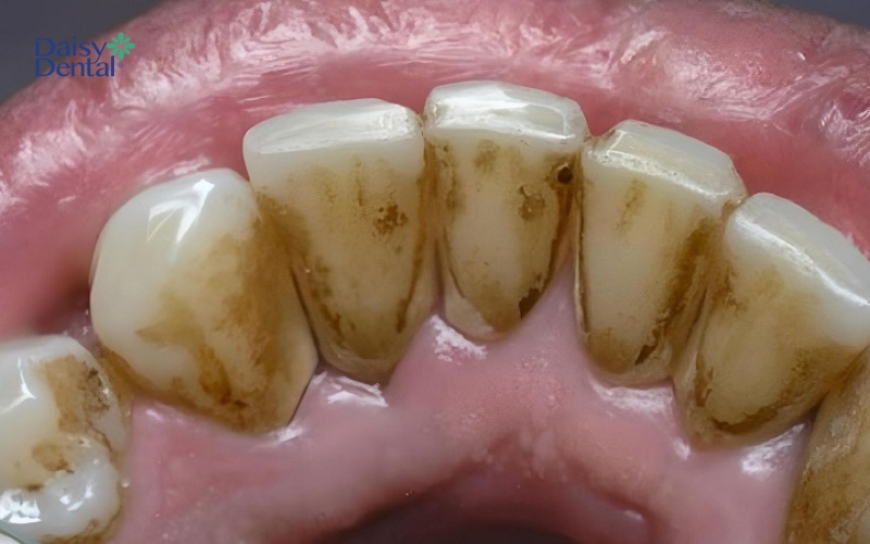 Vôi răng màu vàng ban đầu lâu ngày không được làm sạch sẽ tạo nên vôi răng đen
