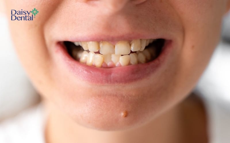 Bác sĩ nhổ bỏ răng sữa để răng vĩnh viễn mọc lên