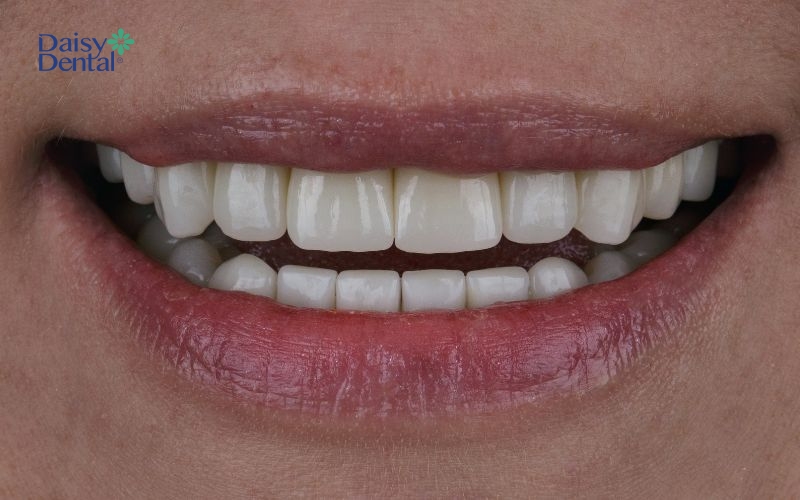 Bọc răng sứ giúp răng trắng sáng và đều hơn