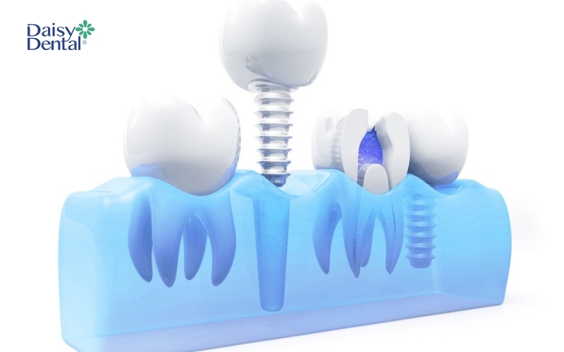 Cấy ghép Implant là giải pháp phục hình răng tối ưu nhất và có chi phí cao