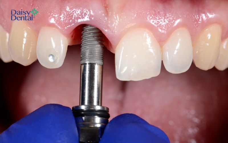 Cấy ghép Implant là giải pháp tối ưu giúp phục hồi răng bị mất