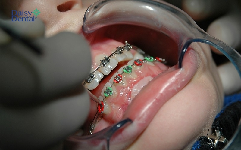 Chỉnh nha là kỹ thuật khắc phục tình trạng răng mọc lệch hiệu quả nhất