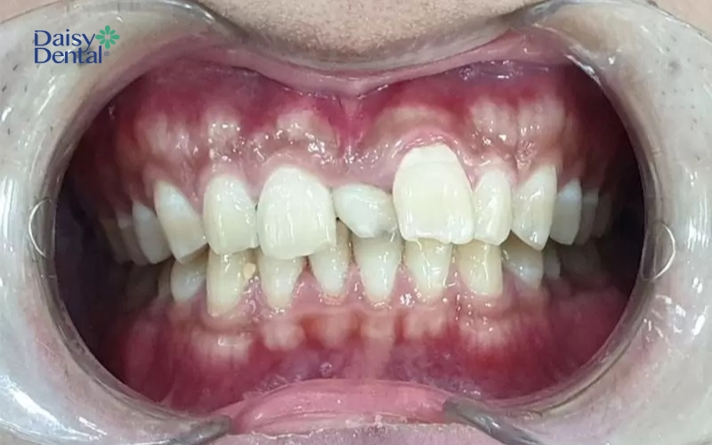 Chưa xác thực nguyên nhân dẫn đến tình trạng răng mọc thừa giữa 2 răng cửa