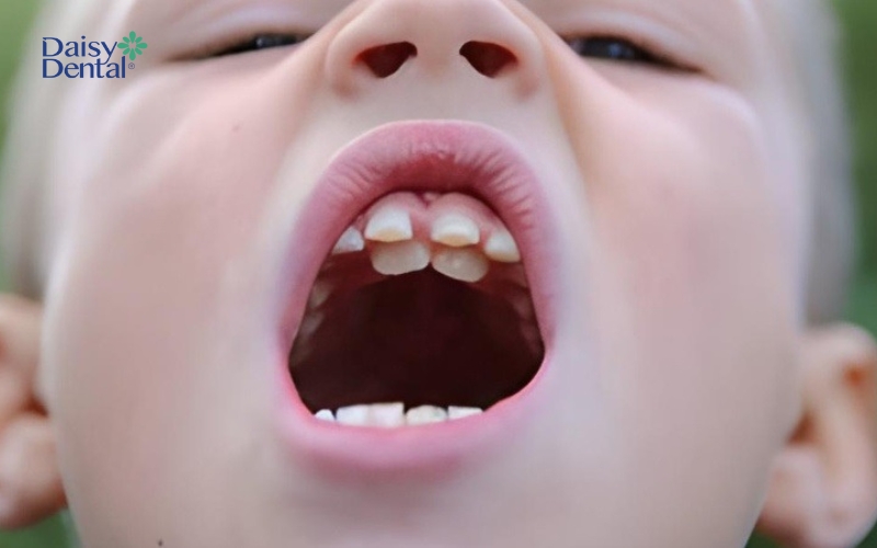 Hiện tượng răng mọc dư, không nằm trên cung hàm